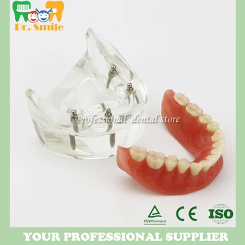 Dantų Dantų Studijų Modelį Overdenture Prastesnės 4 Implantas Demo Modelis