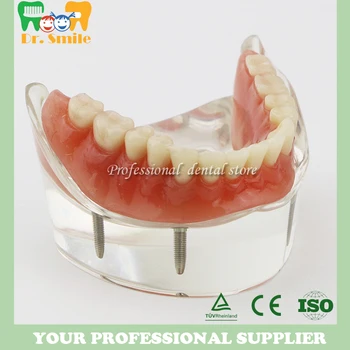 Dantų Dantų Studijų Modelį Overdenture Prastesnės 4 Implantas Demo Modelis