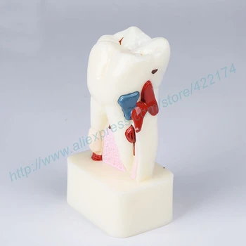 Nemokamas Pristatymas 4size patologinį dantų modelį, dantis, dantys, odontologija, stomatologas anatomijos anatomijos modelis odontologia