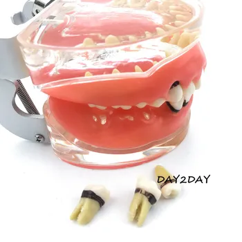 Suaugusiųjų Patologinių Periodonto ligų #4017 Burnos Švietimo Dantų Studijų Dantys Modelis