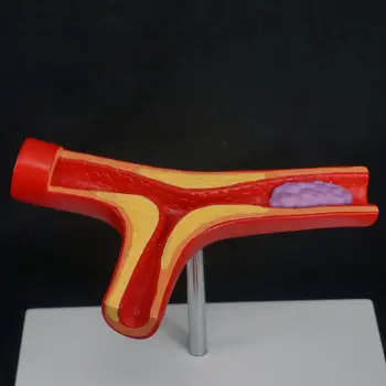 Žmogaus Arterijų Aterosklerozės Aterosklerozės Modelis Trombas Kraujagyslių Medicinos Mokymo Išteklių Modelis